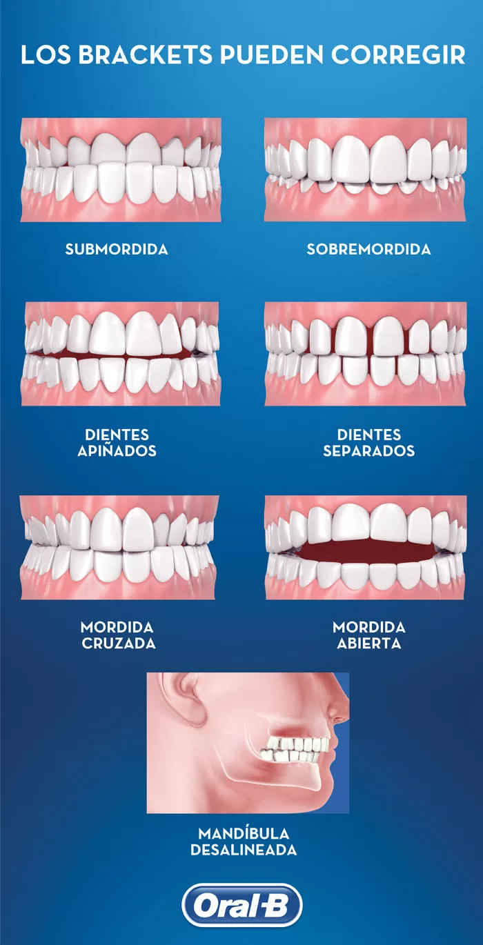 Requisitos para ponerse brackets 2 requisitos para ponerse brackets